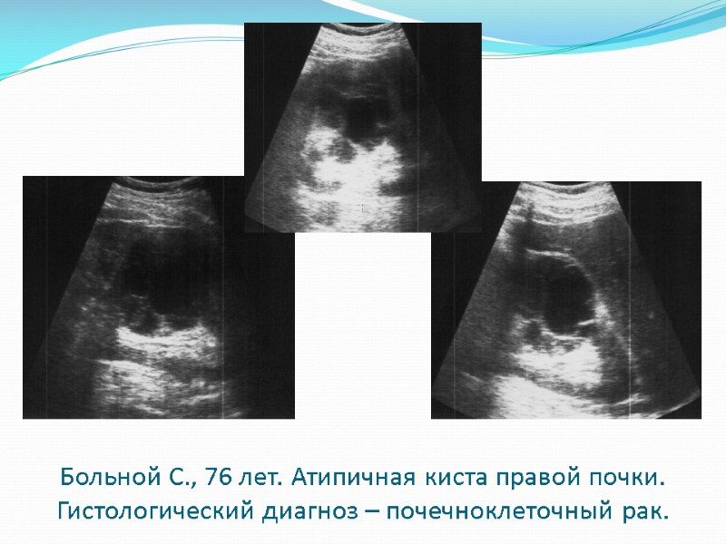 Больной С., 76 лет. Атипичная киста правой почки. Гистологический диагноз – почечноклеточный рак.